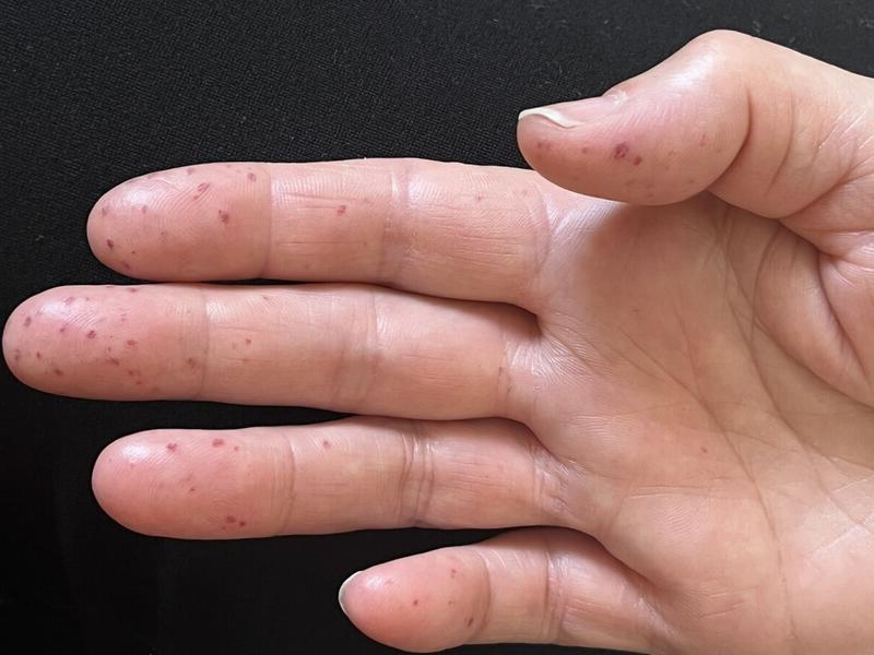 Teleangiektasie Beispiel 2